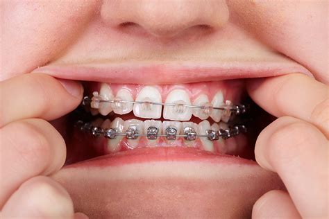 clear bracket braces cost vs metal|ceramic vs metal braces.